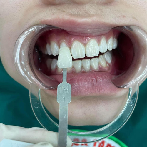 Bọc răng sứ là dịch vụ thế mạnh của Nha khoa Tâm Đức HD