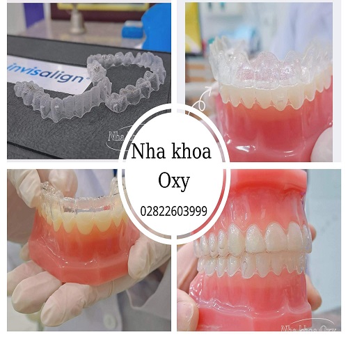 Nha khoa OXY Hóc Môn với dịch vụ niềng răng chất lượng